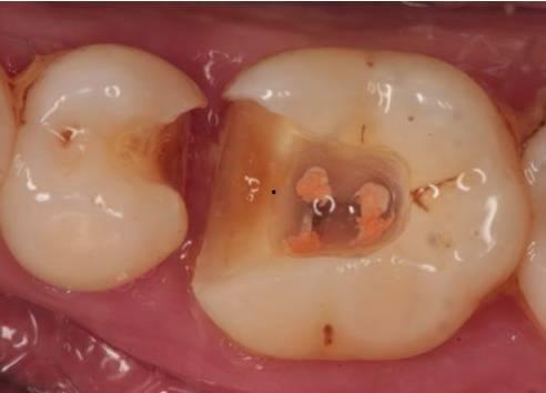 修复体,探索现代修复体技术的奇迹